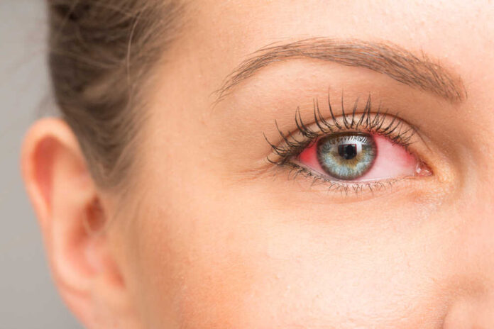 Use these tips to prevent and treat dry eyes this winter
